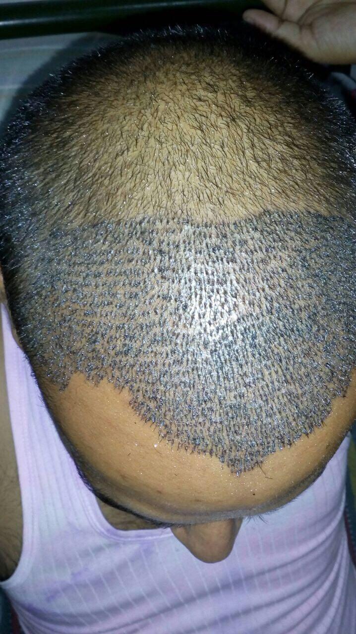 Best Hair Wig And Hair Patch In Patna Hi Handsome Patna  Patna  Clickin