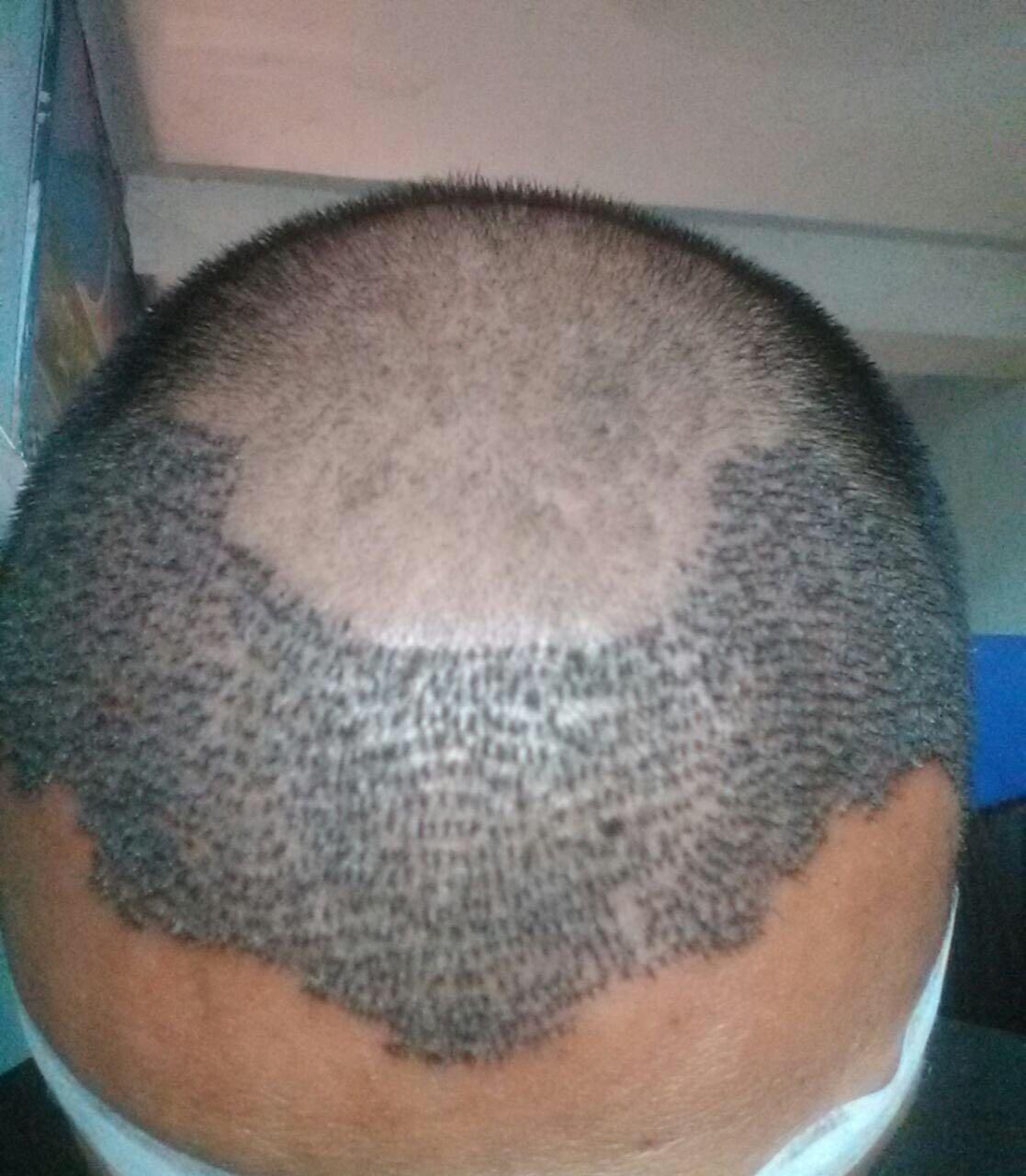 Advance Hair Transplant Centre - Best Hair Transplant Surgeons in Kankarbagh, Patna. Advance Hair Transplant Centre - Best Hair Transplant Surgeons in Kankarbagh, Patna.